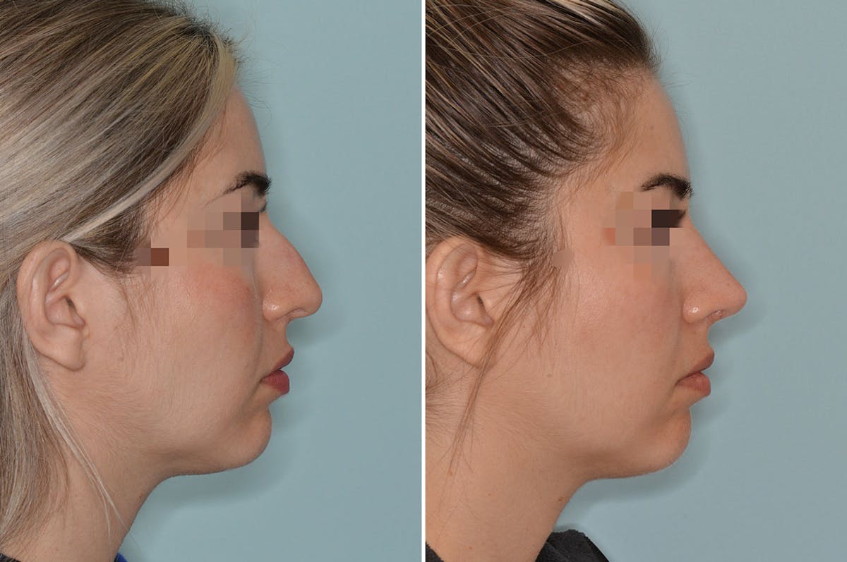 Rhinoplasty before and after, lateral right.