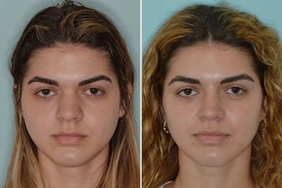 Rhinoplasty before and after, frontal.