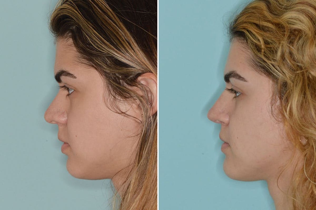Rhinoplasty before and after, lateral left.