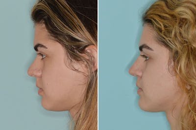 Rhinoplasty before and after, lateral left.