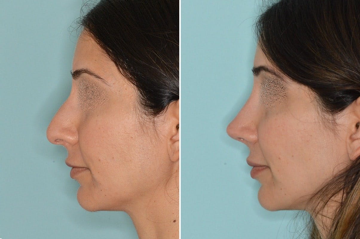 Rhinoplasty before and after, lateral left.