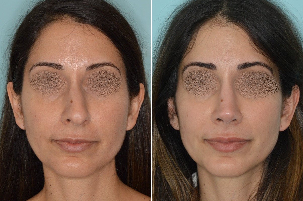 Rhinoplasty before and after, frontal.