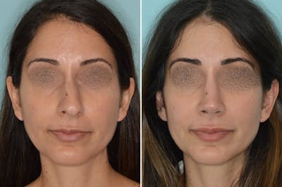 Rhinoplasty before and after, frontal.
