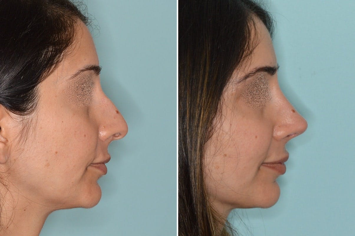 Rhinoplasty before and after, lateral right.