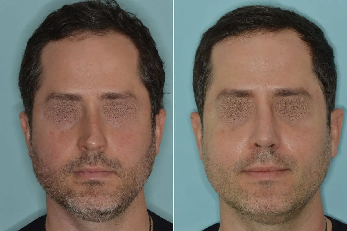 Rhinoplasty before and after, frontal.