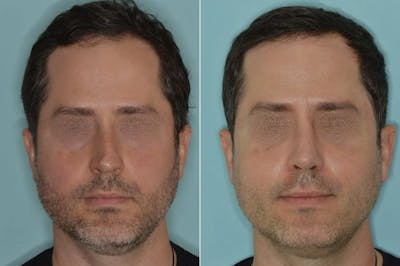Rhinoplasty before and after, frontal.