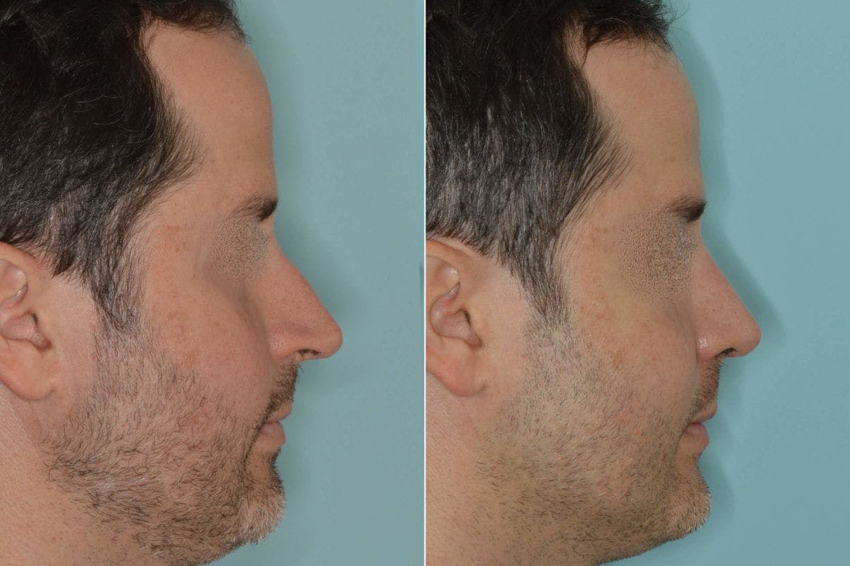 Rhinoplasty before and after, lateral right.