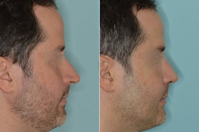 Rhinoplasty before and after, lateral right.