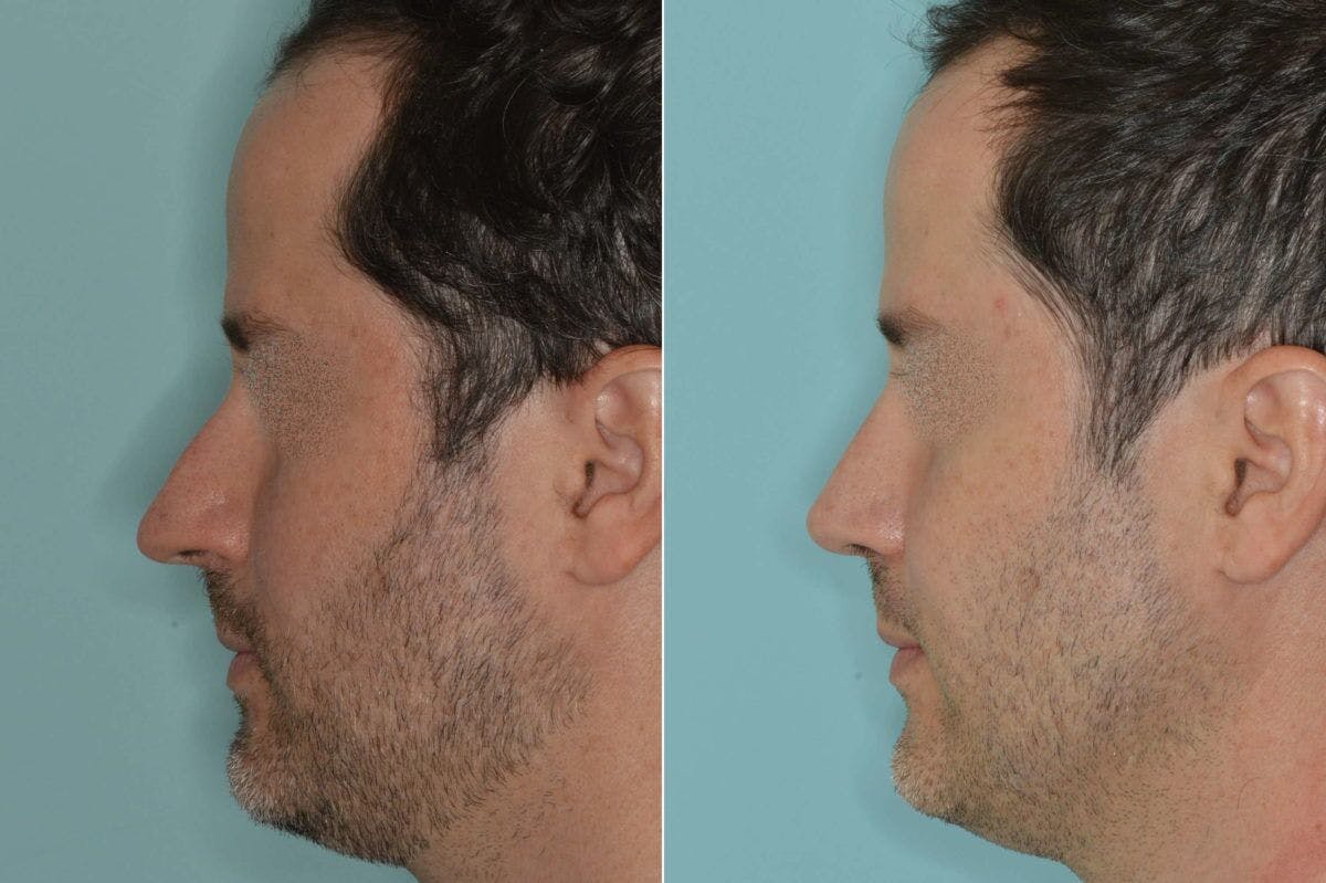 Rhinoplasty before and after, lateral left.