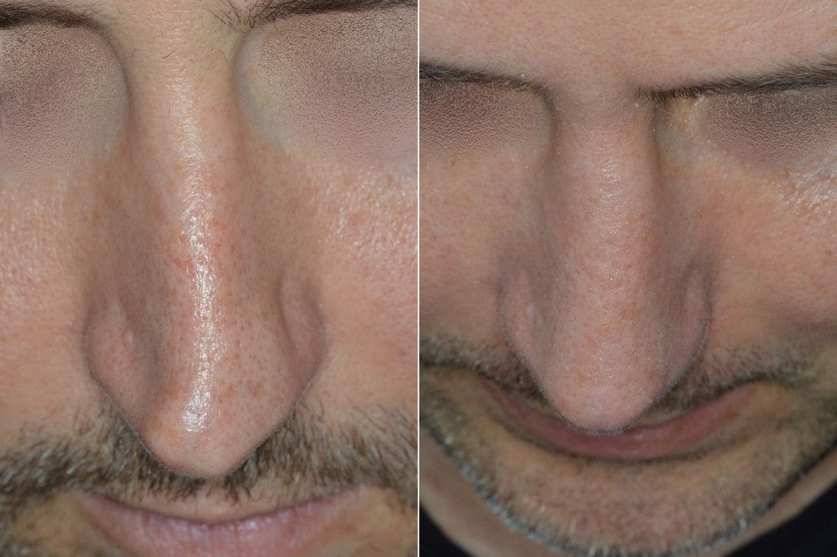 Rhinoplasty before and after, frontal.