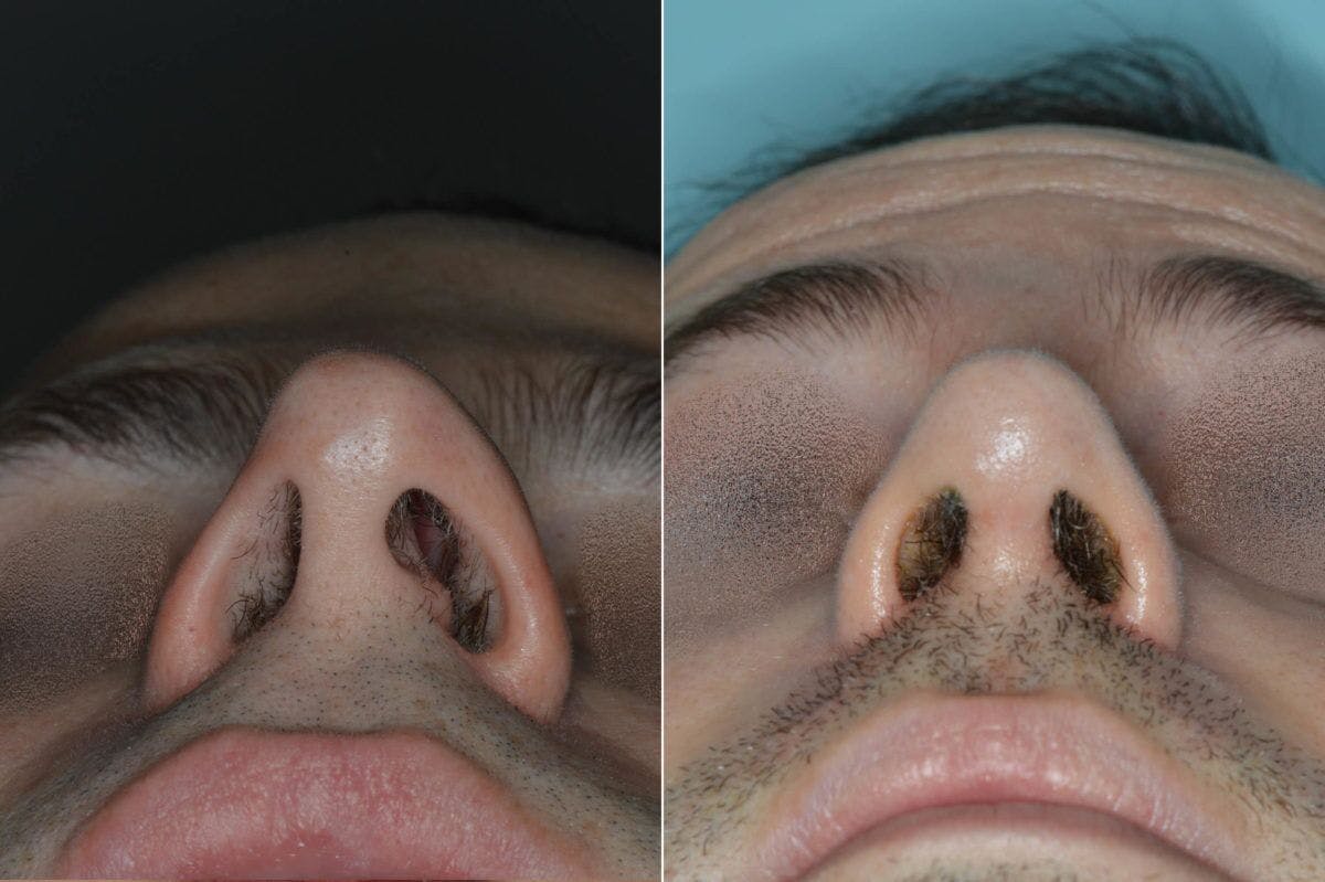 Rhinoplasty before and after, frontal.