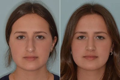 Rhinoplasty before and after, frontal.