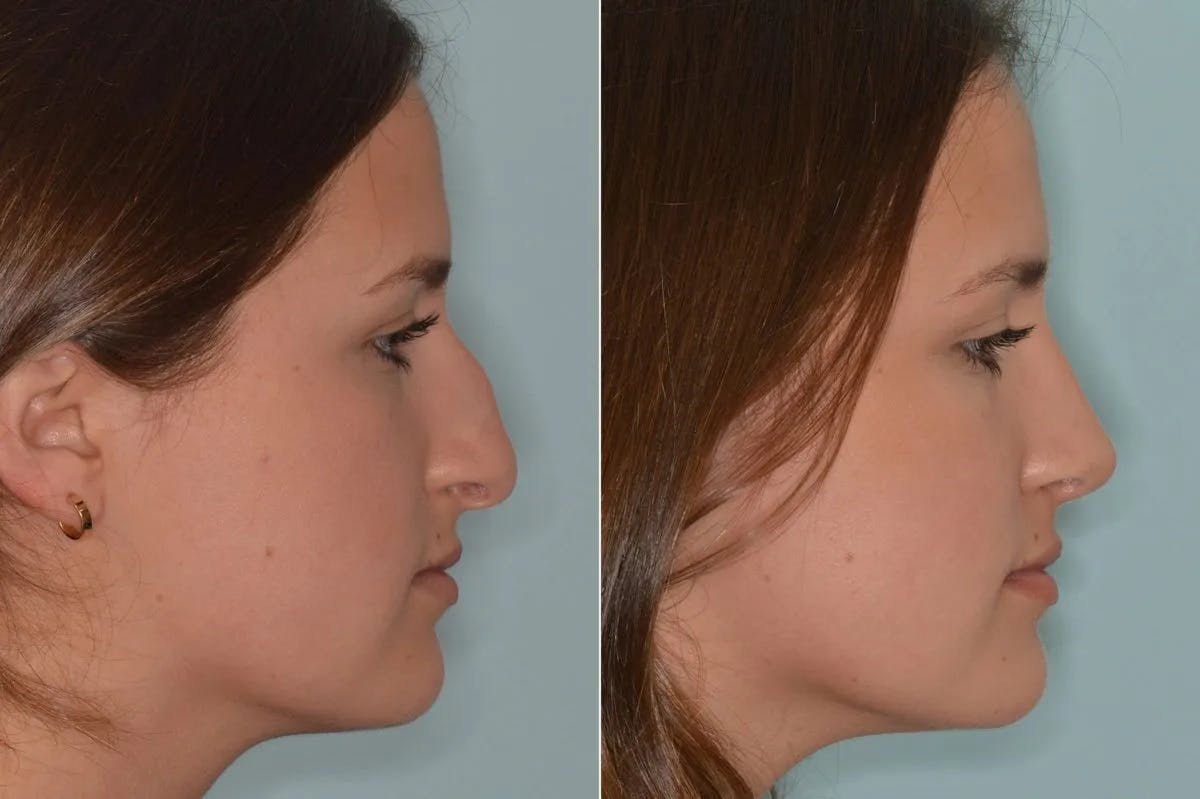 Rhinoplasty before and after, lateral right.