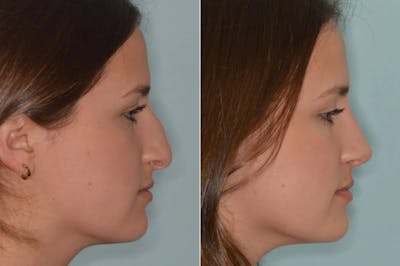 Rhinoplasty before and after, lateral right.