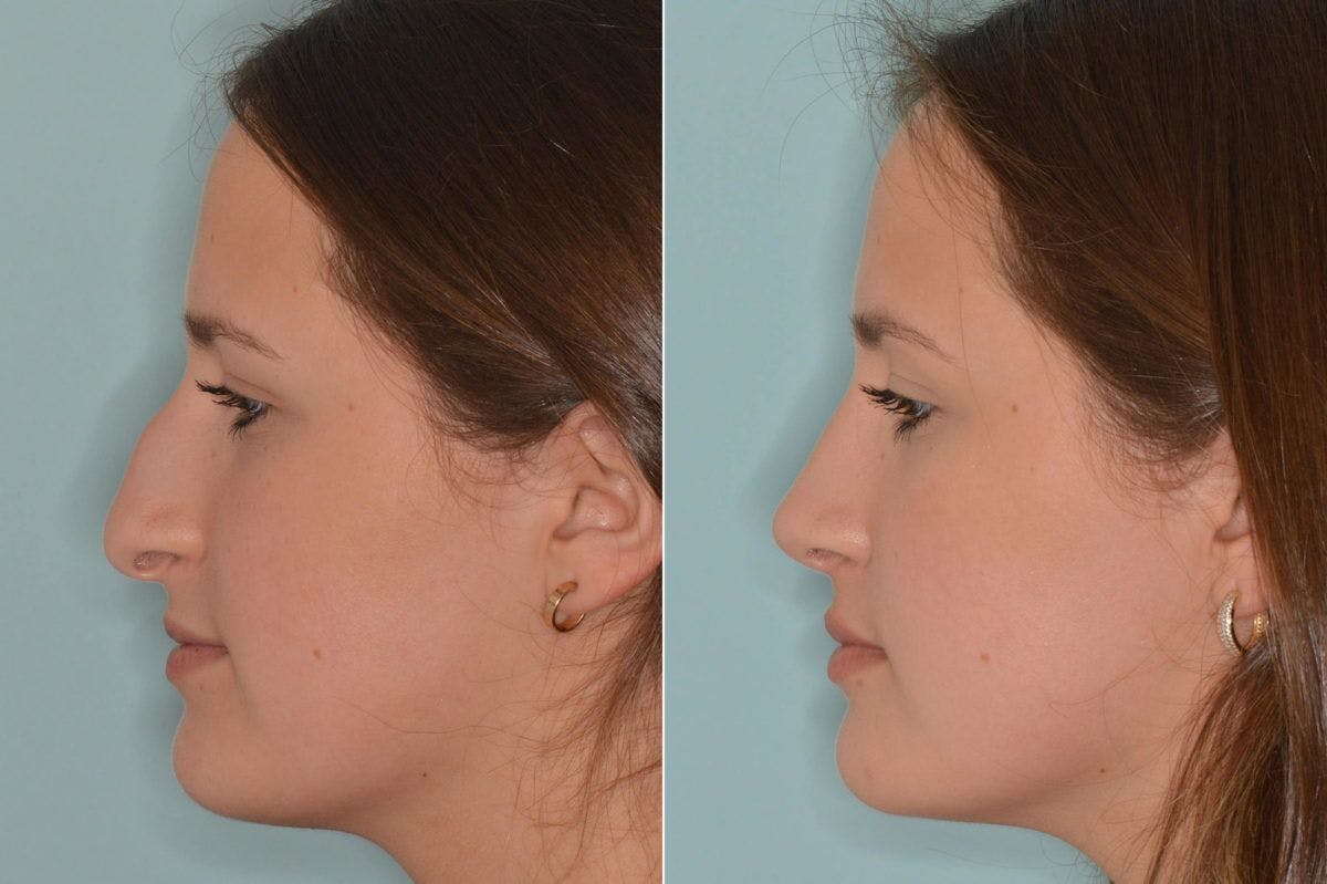Rhinoplasty before and after, lateral left.