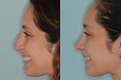 Rhinoplasty before and after, lateral left.