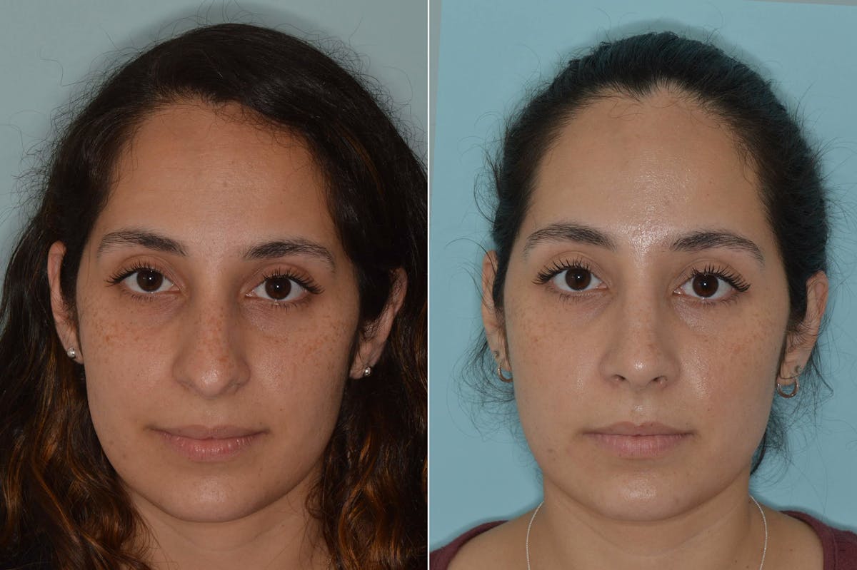 Rhinoplasty before and after, frontal.