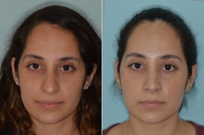 Rhinoplasty before and after, frontal.