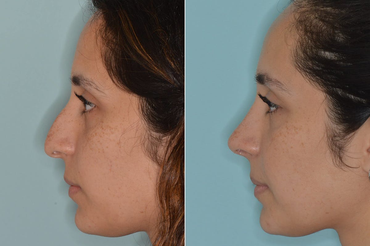 Rhinoplasty before and after, lateral left.