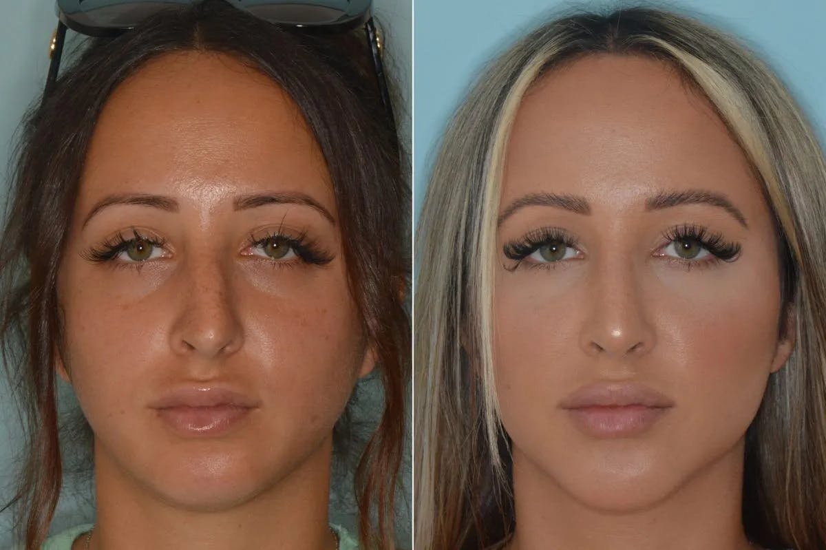 Rhinoplasty before and after, frontal.