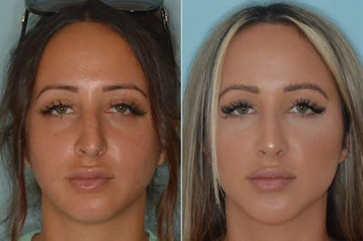 Rhinoplasty before and after, frontal.