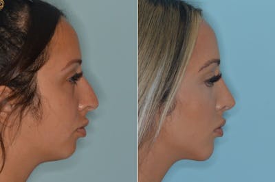 Rhinoplasty before and after, lateral right.