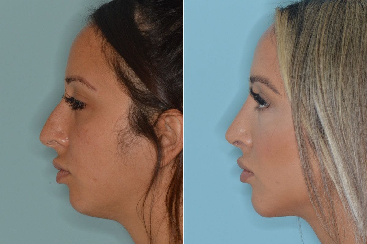 Rhinoplasty before and after, lateral left.