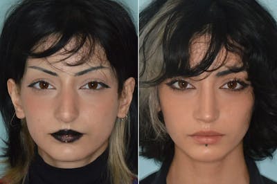 Rhinoplasty before and after, frontal.