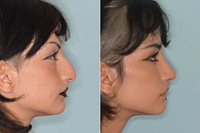 Rhinoplasty before and after, lateral right.