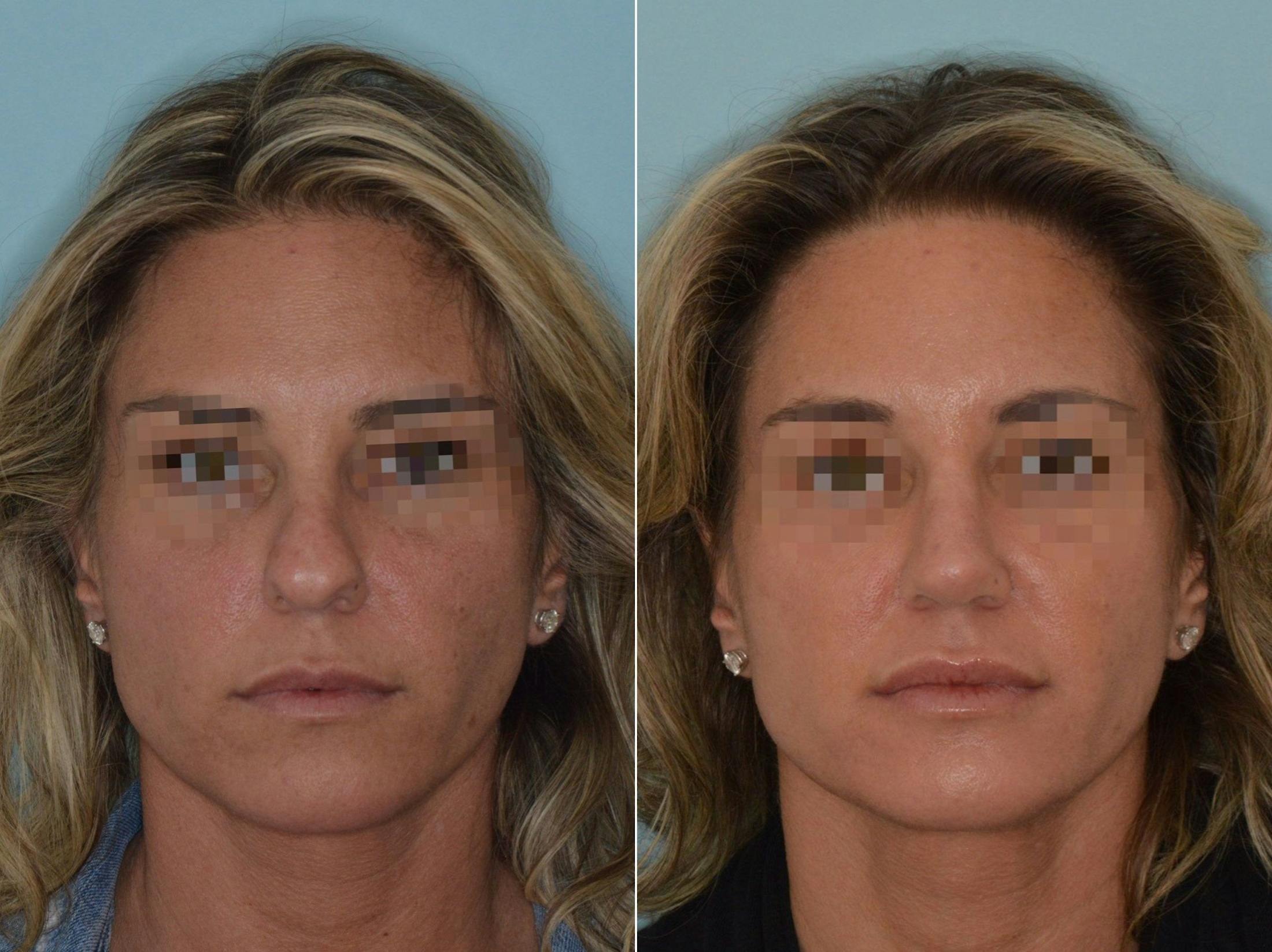 Rhinoplasty before and after, frontal.