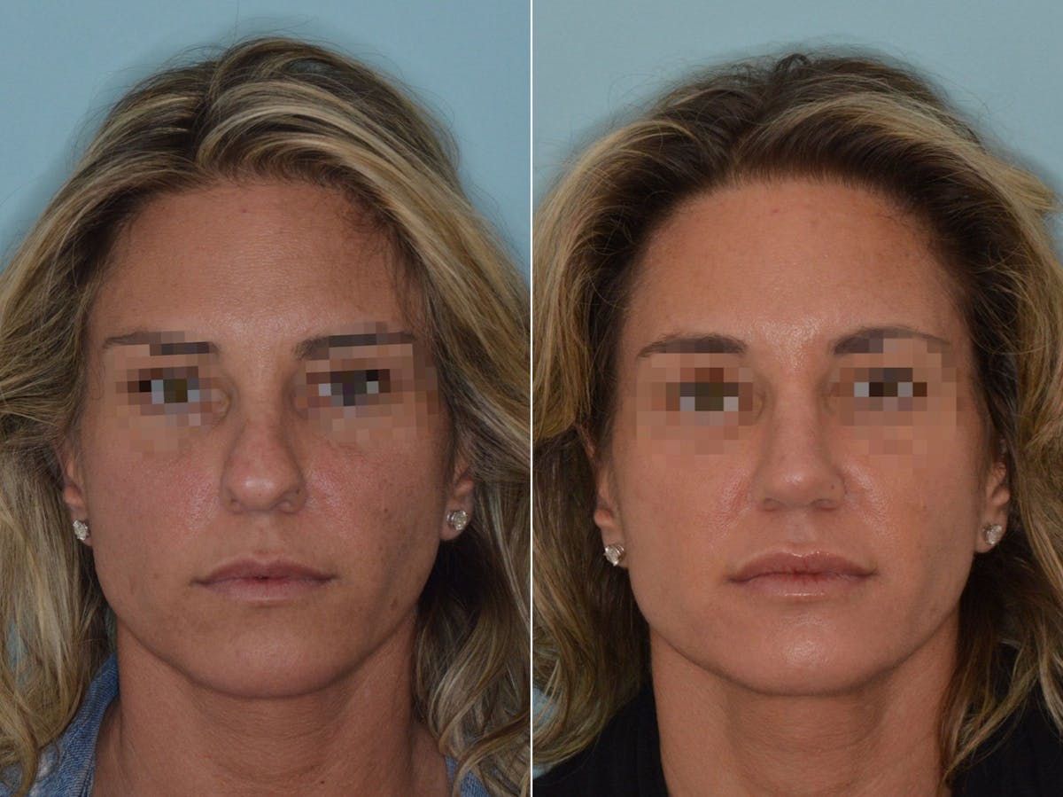 Rhinoplasty before and after, frontal.