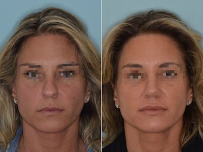 Rhinoplasty before and after, frontal.