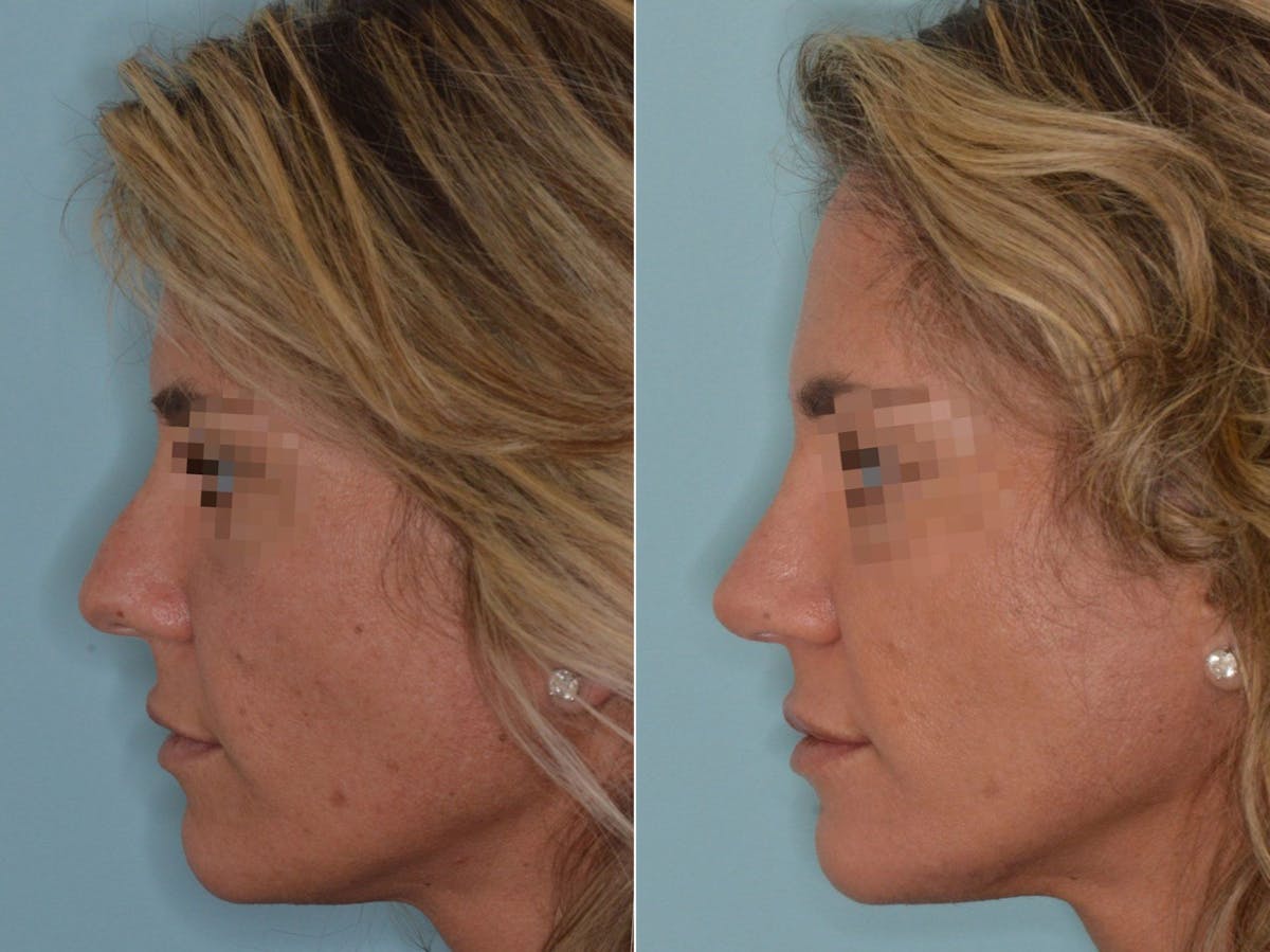 Rhinoplasty before and after, lateral left.
