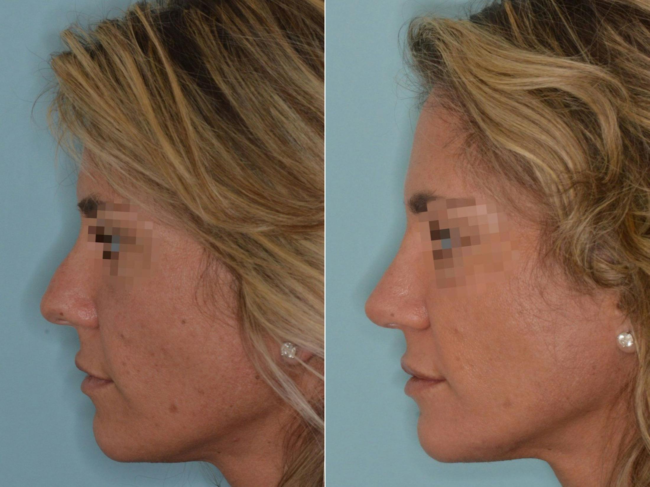 Rhinoplasty before and after, lateral left.