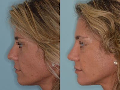 Rhinoplasty before and after, lateral left.