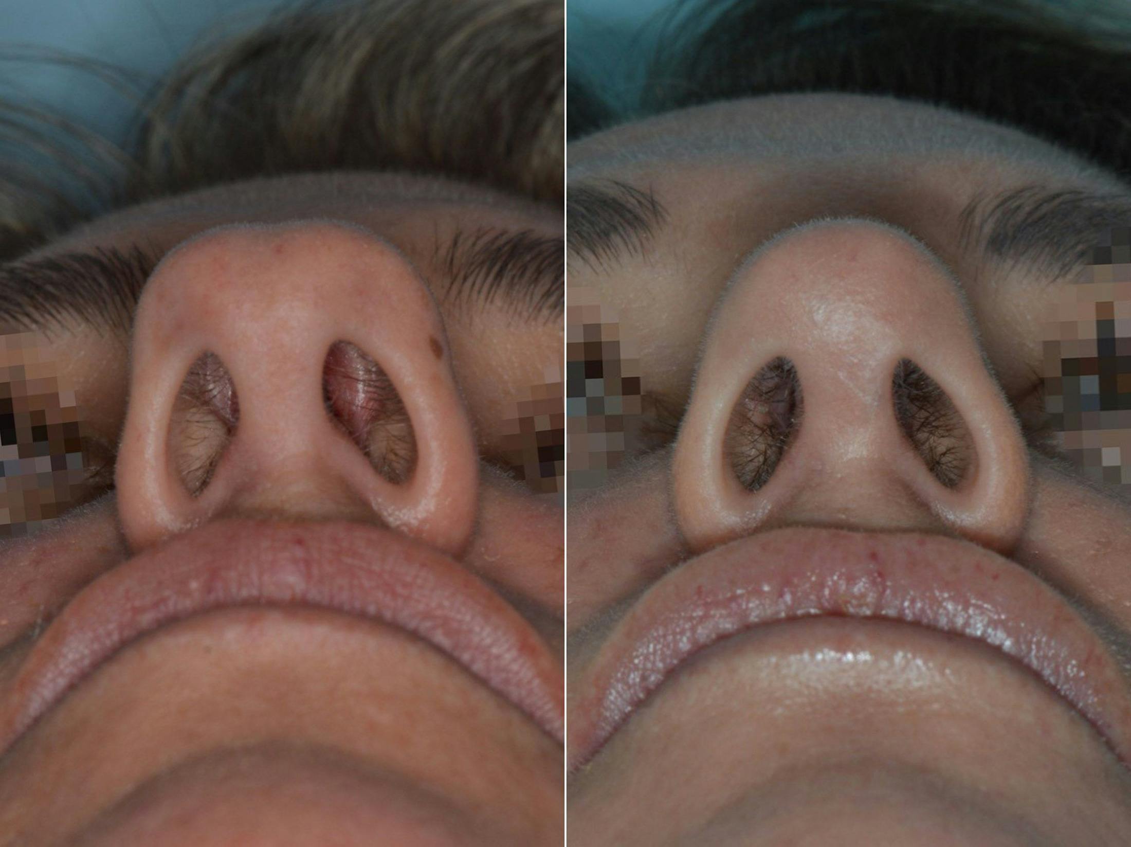 Rhinoplasty before and after, frontal.