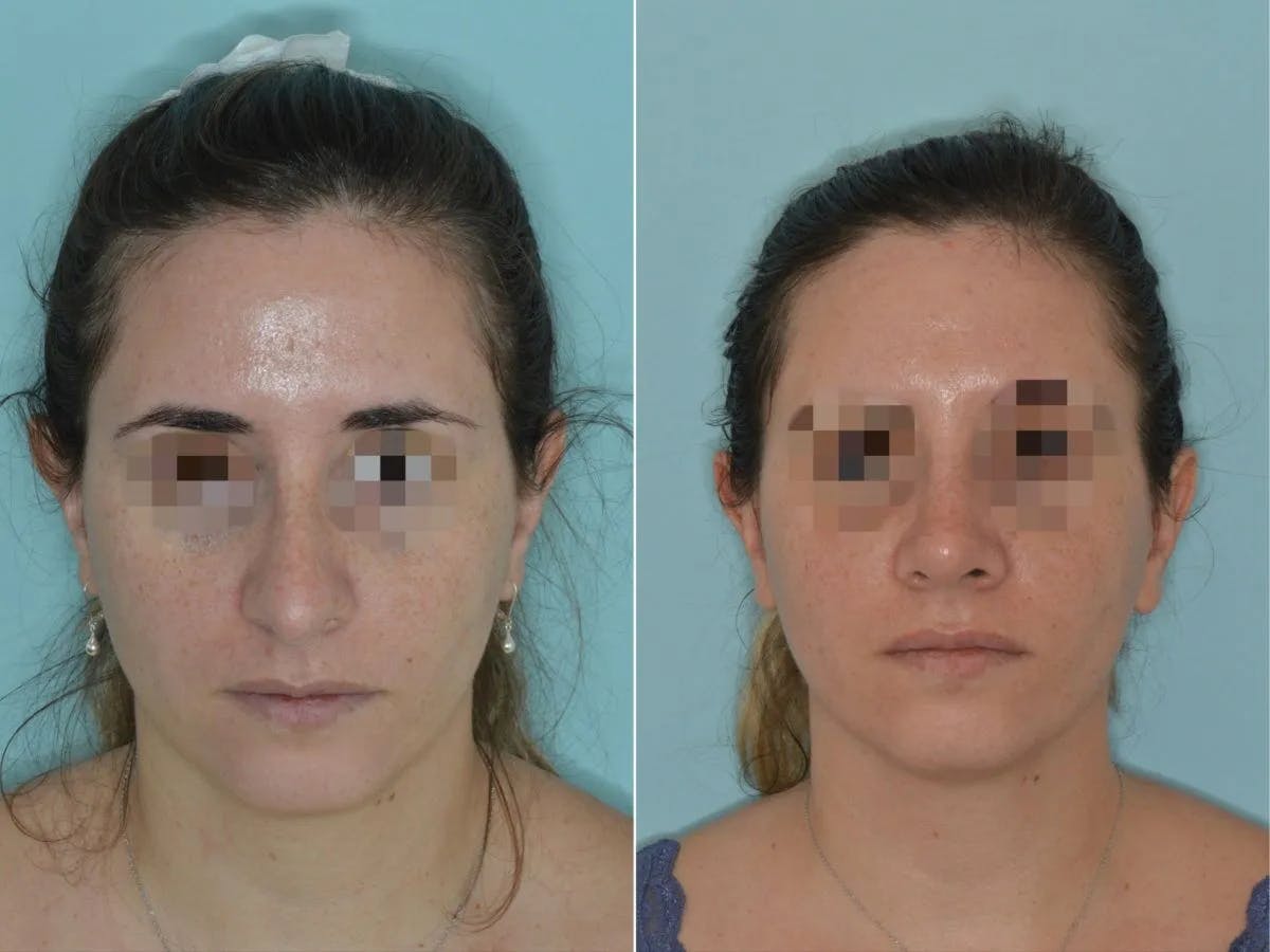 Rhinoplasty before and after, frontal.
