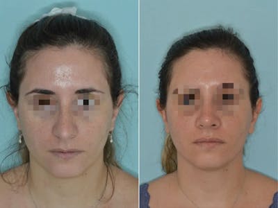 Rhinoplasty before and after, frontal.
