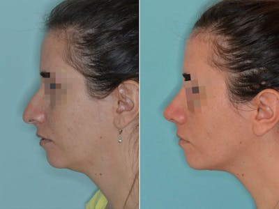 Rhinoplasty before and after, lateral left.
