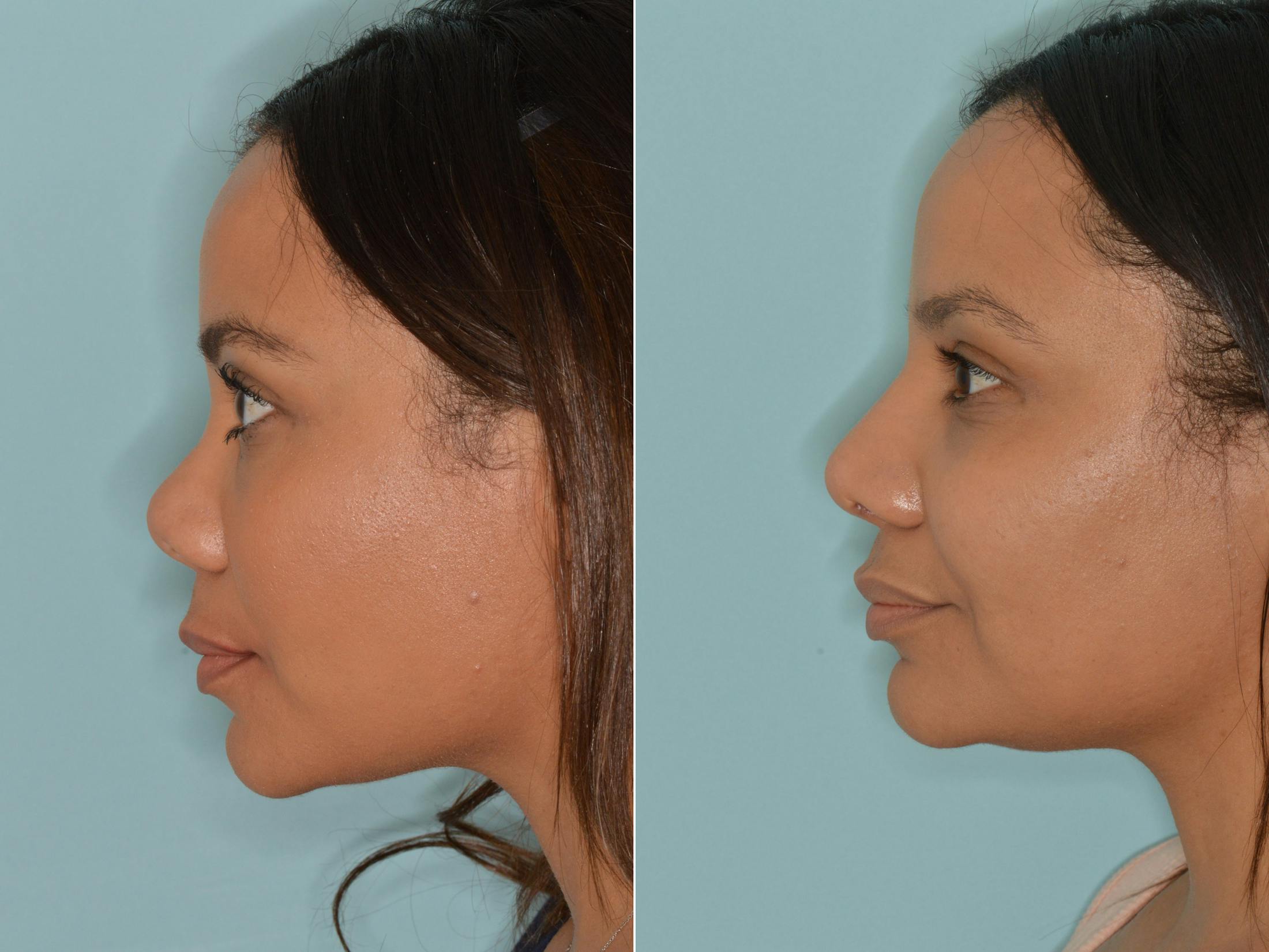 Rhinoplasty before and after, lateral left.