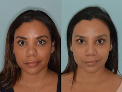 Rhinoplasty before and after, frontal.