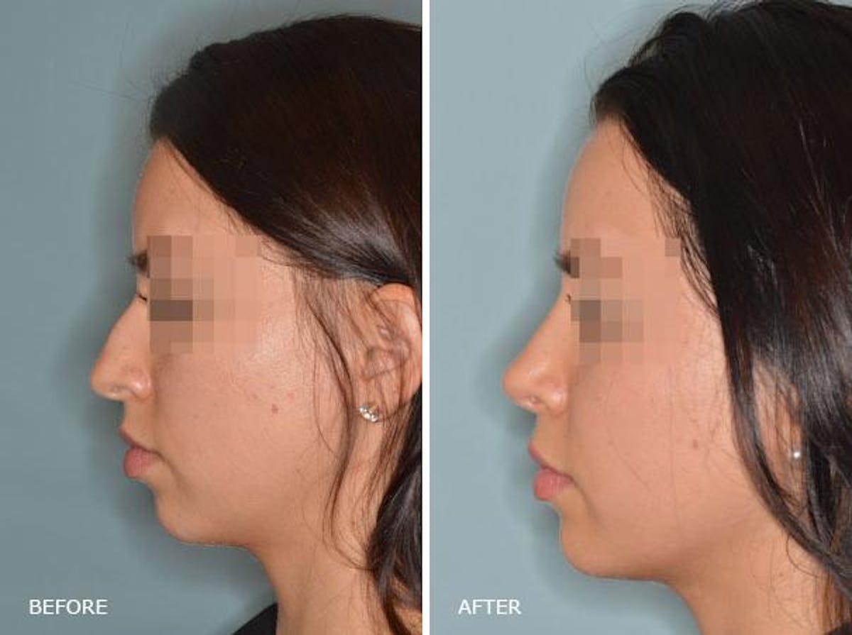 Rhinoplasty before and after, lateral left.