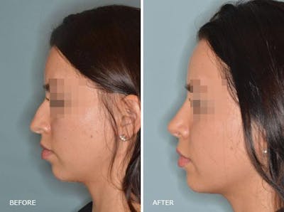 Rhinoplasty before and after, lateral left.