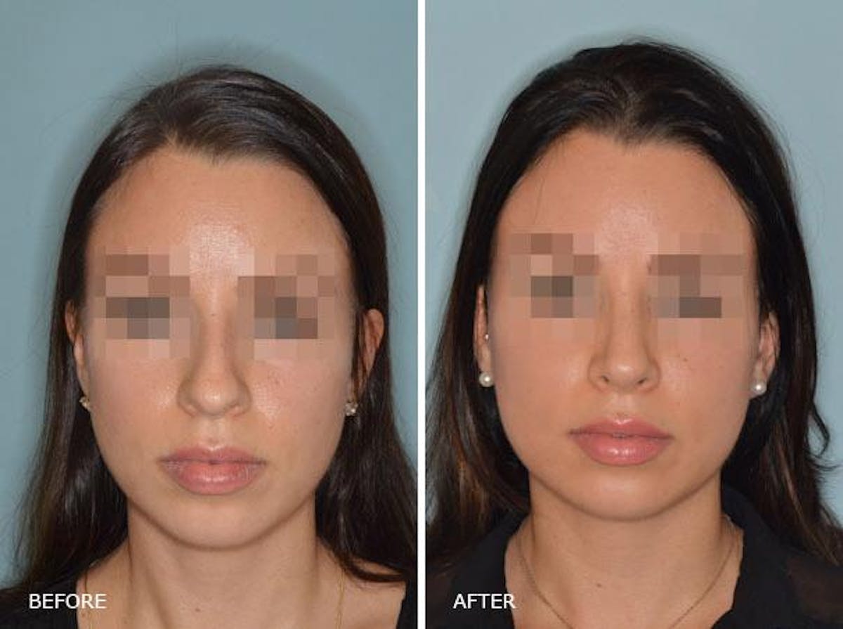 Rhinoplasty before and after, frontal.