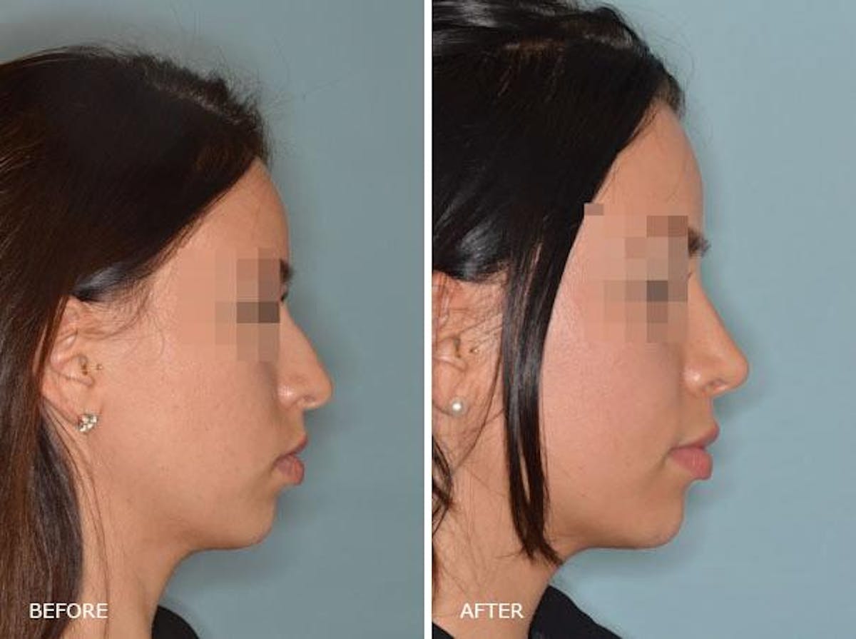 Rhinoplasty before and after, lateral right.