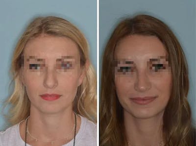 Rhinoplasty before and after, frontal.