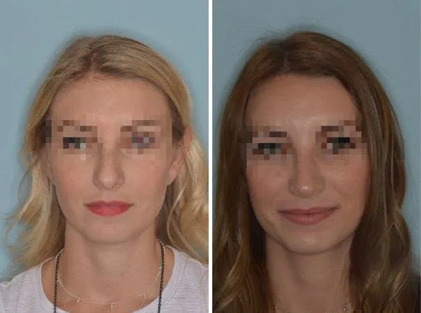 Rhinoplasty before and after, frontal.