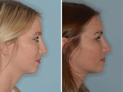 Rhinoplasty before and after, lateral right.