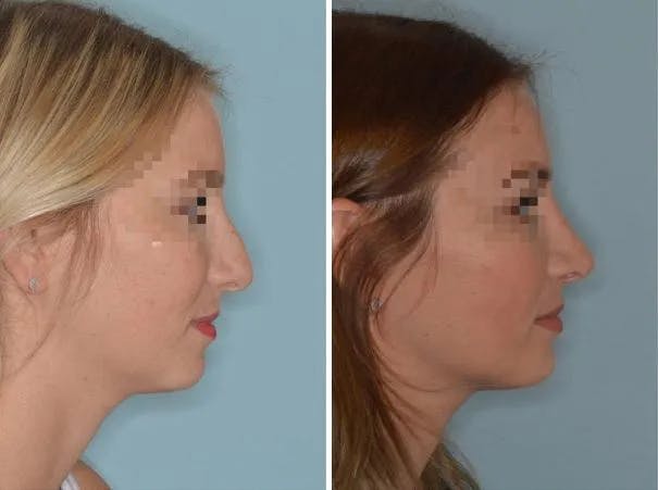 Rhinoplasty before and after, lateral right.