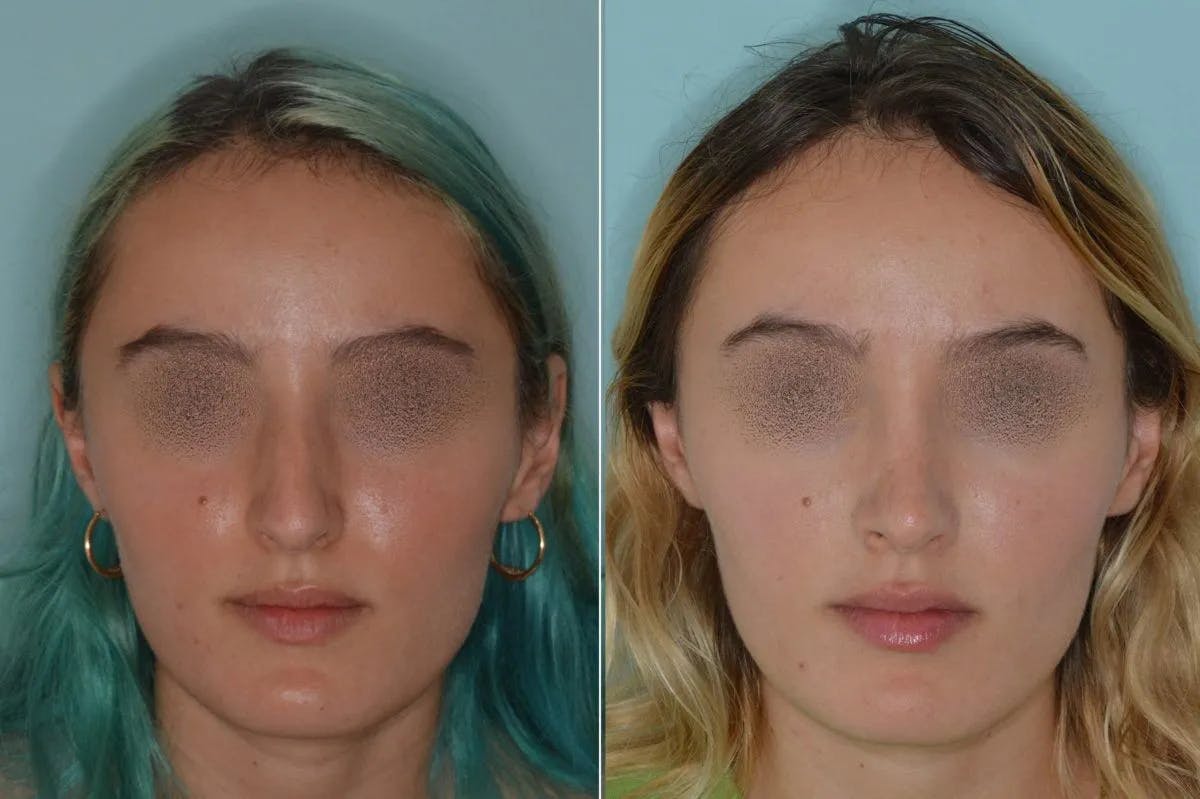 Rhinoplasty before and after, frontal.